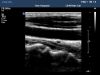 PHILIPS L8-4 Ultrasound Transducer