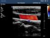 PHILIPS L8-4 Ultrasound Transducer