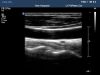 PHILIPS L17-5 Ultrasound Transducer
