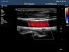 PHILIPS L17-5 Ultrasound Transducer
