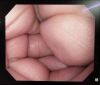 OLYMPUS GIF-Q150X Endoscope