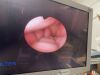 OLYMPUS URF Type P3 Ureteroscope