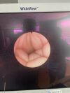 KARL STORZ 11278A1 Endoscope