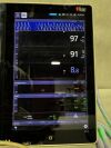MASIMO Root RDS7A with Radical-7 Monitor