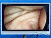 STRYKER 1488 Tower  Lcd Monitor  YOM: 2017 Laparoscope