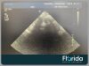 PHILIPS S5-1 CARDIAC SECTOR ARRAY TRANSDUCER PROBE REF 453561176743 30 DAYS WARRANTY Ultrasound Transducer