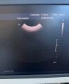 PHILIPS C8-5 Micro Convex Ultrasound Transducer