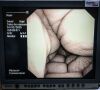 OLYMPUS BF-160 Bronchoscope