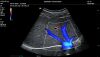 MINDRAY M8 Elite Ultrasound - Cardiac