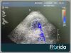 PHILIPS S4-1 CARDIAC SECTOR TRANSDUCER PROBE TESTED Ultrasound Transducer