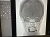 PHILIPS Allura FD20/20 Angio Lab