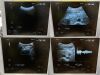 HITACHI HI VISION Avius Ultrasound - OB / GYN