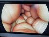STRYKER 1588 camera console with L10 LED light source with head and SDC image management system Laparoscope