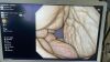 OLYMPUS GIF-1200N Gastroscope