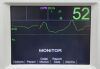 ZOLL R Series ALS Defibrillator Monitor W/ 3-Lead, Printer &amp; Pacer - 202000 Defibrillator