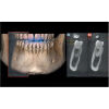 NEWTOM Giano HR Prime Pan + CBCT (FOV 10x8) Dental X-Ray