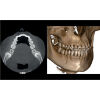 NEWTOM Giano HR Prime Pan + CBCT (FOV 10x8) Dental X-Ray