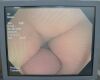 OLYMPUS Evis Exera II PCF-H180AL Video - 204039 H180AL