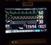 PHILIPS MX450 ICU/CCU
