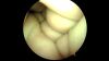 RICHARDS 23-0851 Arthroscope