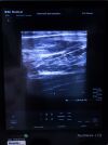 BK MEDICAL 8870 Ultrasound Transducer