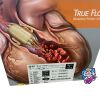 BARD TF0183511 True Flow Perfusion Catheter