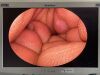 OLYMPUS WA20017A Hysteroscope