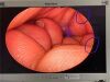 OLYMPUS WA20017A Hysteroscope