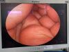 OLYMPUS WA20017A Hysteroscope
