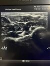 PHILIPS L12-5 Ultrasound Transducer