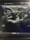 PHILIPS L12-5 Ultrasound Transducer