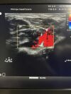 PHILIPS L12-5 Ultrasound Transducer