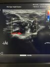 PHILIPS L12-5 Ultrasound Transducer