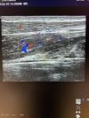 GE ML6-15-D Ultrasound Transducer