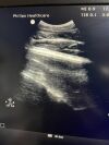PHILIPS C5-1 Ultrasound Transducer