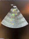 GE 6Tc Ultrasound Transducer