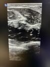 PHILIPS MEDICAL L15-7io Ultrasound Transducer