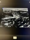 PHILIPS L12-3 Ultrasound Transducer