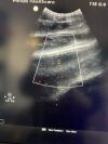 PHILIPS C5-1 Ultrasound Transducer