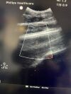 PHILIPS C5-1 Ultrasound Transducer