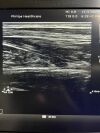 PHILIPS L12-5 Ultrasound Transducer