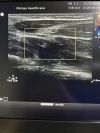 PHILIPS L12-5 Ultrasound Transducer