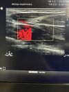 PHILIPS L12-5 Ultrasound Transducer