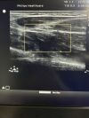 PHILIPS L12-5 Ultrasound Transducer
