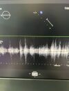 PHILIPS X5-1 Ultrasound Transducer