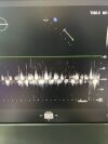 PHILIPS X5-1 Ultrasound Transducer