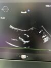 PHILIPS X5-1 Ultrasound Transducer