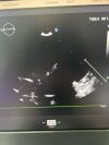 PHILIPS X5-1 Ultrasound Transducer