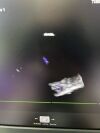 PHILIPS X5-1 Ultrasound Transducer