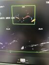 PHILIPS X5-1 Ultrasound Transducer
